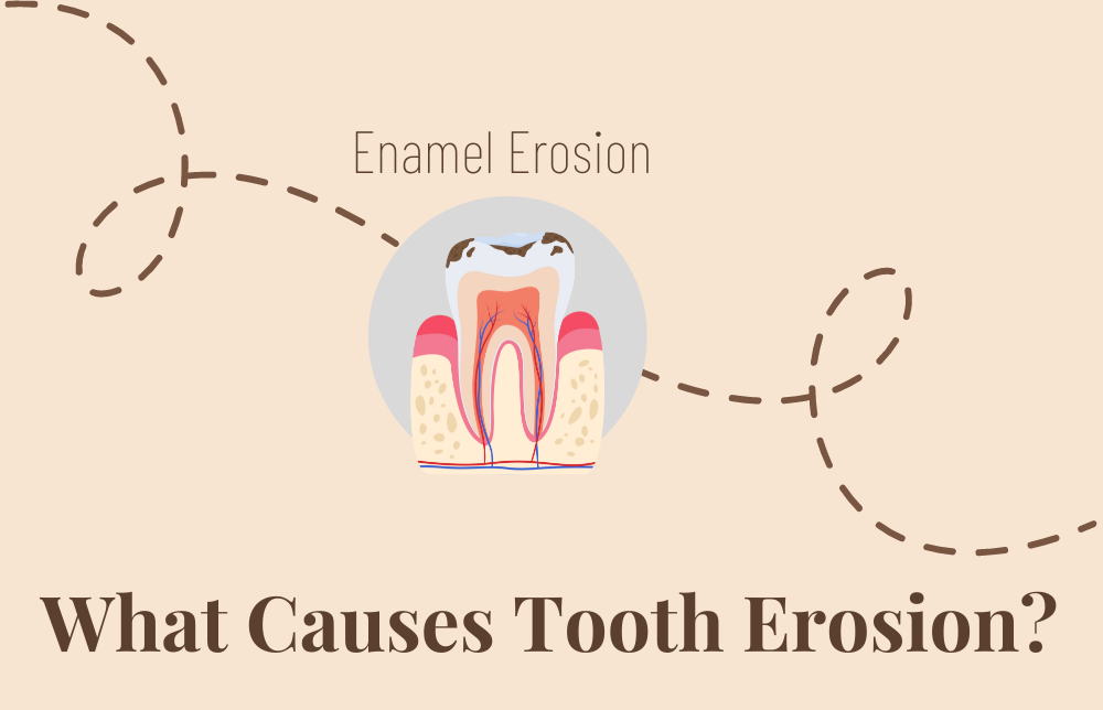 What Causes Tooth Erosion?